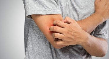 Mantar Hastalığı Hakkında Bilinmesi Gereken 6 Önemli Bilgi!